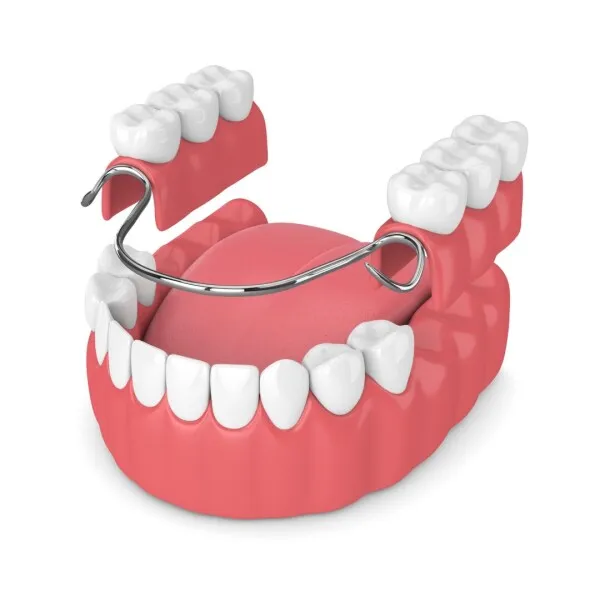 Couronne dentaire (CEREC) et pont dentaire